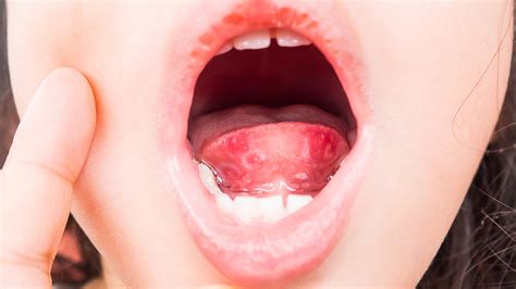 Bumps On Back Of Tongue Causes Large White Red Bumps Remedies And