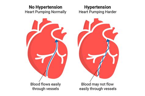 High Blood Pressure Guidelines Aandd Medical