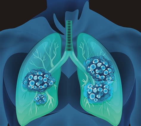 Combination Therapy Improves Small Cell Lung Cancer Survival Vanderbilt Medicine Vanderbilt