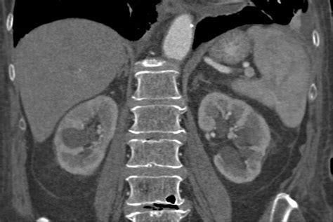 Acute Pyelonephritis Involving Left Kidney Kidney Case Studies