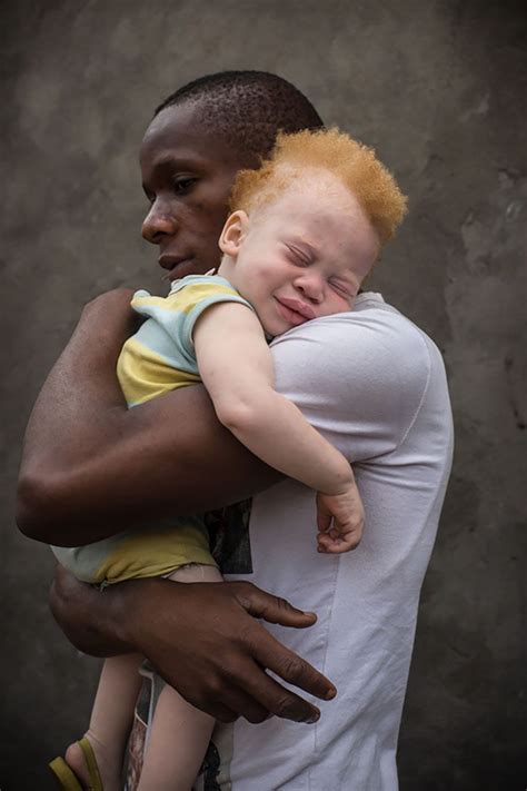Albino Black Person Images Printable Template Calendar