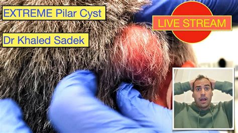 Explosive Stream Pilar Cyst Live Dr Khaled Sadek Lipomacyst Com