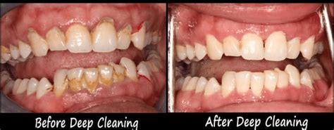 Deep Cleaning Of Teeth Side Effects How To Overcome It