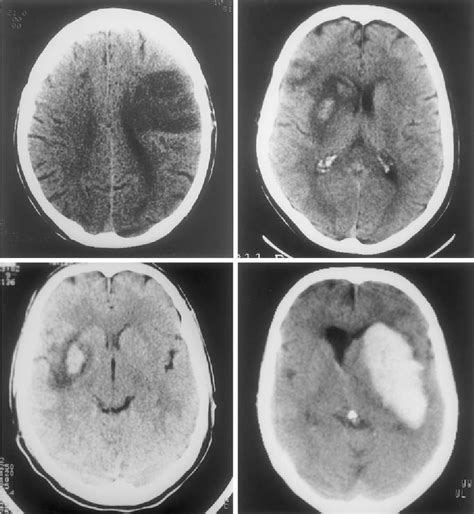 Figure 1 From Hemorrhagic Transformation Within 36 Hours Of A Cerebral
