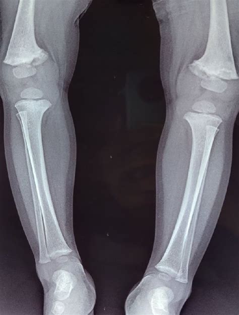 Rickets Before And After Treatment