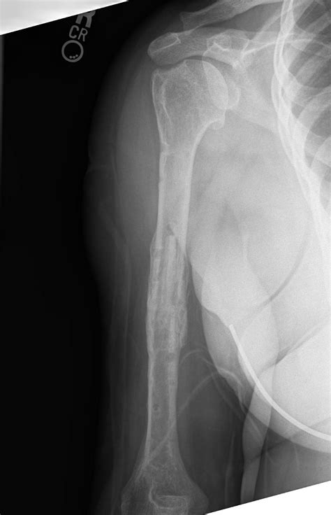 Non Union Humerus Fracture Therapy Fracture