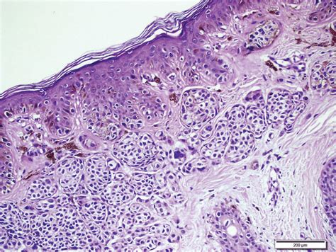 Histologically Normal Melanocytes Arranged In Nests In The Dermis And
