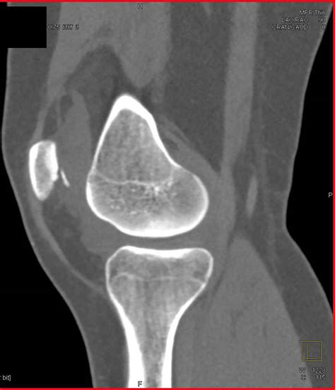 Patella Fracture With Hematoma Trauma Case Studies Ctisus Ct Scanning