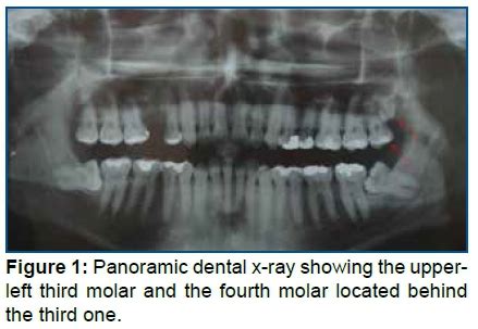 A Rare Case Of A Maxillary Fourth Molar Case Report