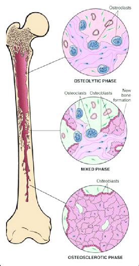 Pathogenesisphases Of Pagets Disease Of Bone Download Scientific