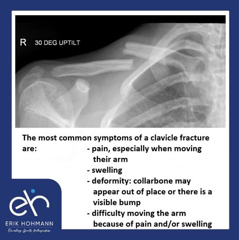 The Most Common Symptoms Of A Clavicle Fracture Are Dubai Sports