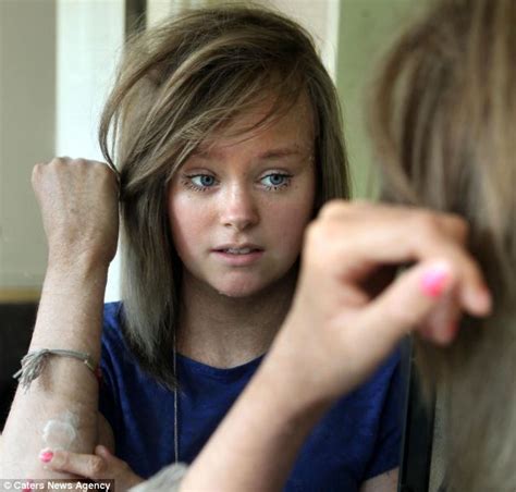 The Teenage Sisters Who Shed All Their Skin Every Day Due To