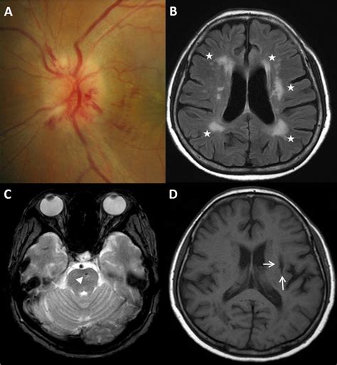 Cerebral Small Vessel Disease In A Patient With Naion A A Case Of