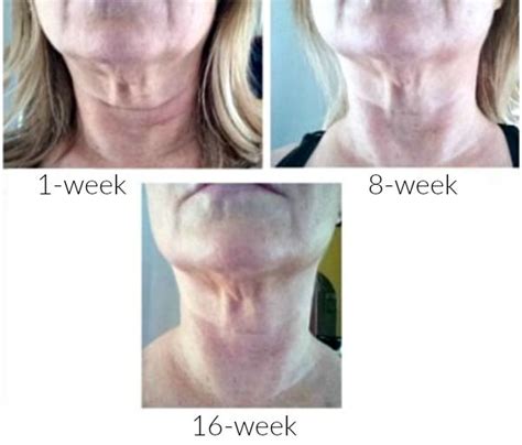 Fix Sagging Neck Skin 10 Non Surgical Tips For Beautiful Results