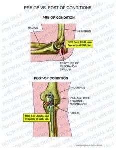 95040a Pre-Op VS. Post-Op of Ulnar Fracture - Medical Visions