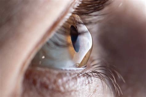 Die symptome äußern sich in abhängigkeit der stärke und häufig kneifen betroffene die augen zusammen, um den sehfehler zu korrigieren. Hornhautverkrümmung / Astigmatismus | Augenarzt Dr. Robert ...