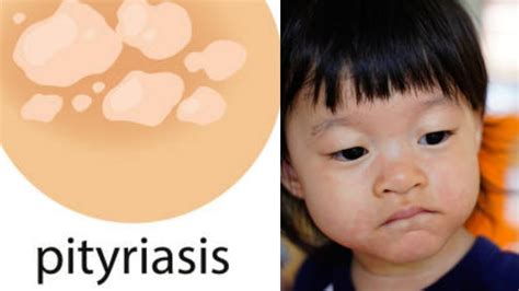 White Patchesspots On Your Child Facepityriasis Alba Vs Vitiligohome