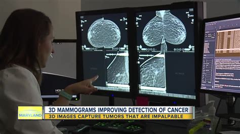 3d Mammograms Used To Detect Breast Cancer