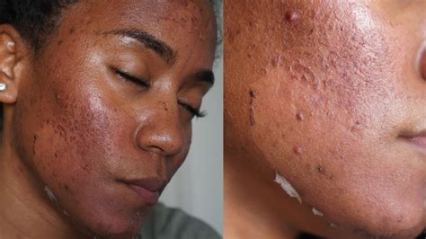 Green Peel Full Process Procedure Peeling Before And After No