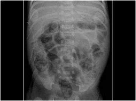 Pediatrics Pediatric Abdomen And Retroperitoneum Case Necrotizing Enterocolitis