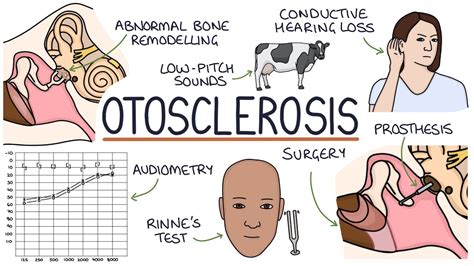 Understanding Otosclerosis Youtube