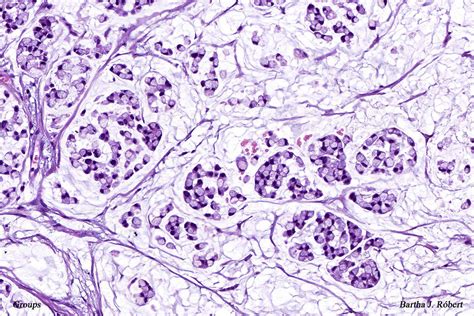 Groups Lymph Node Metastasis Of Signet Ring Cell Carcinoma Flickr