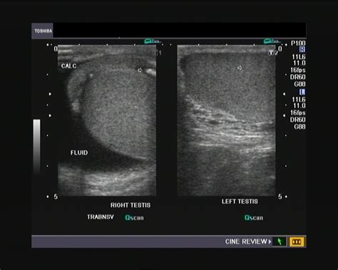 Cochinblogs The Role Of Ultrasound Imaging In The Diagnosis Of Scrotal