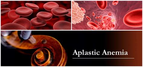 Aplastic Anemia Chandigarh Cancer And Diagnostic Center