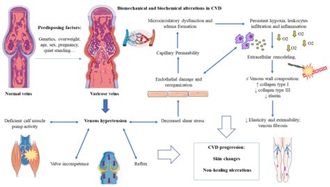 Pathophysiology Of Chronic Venous Disease And Venous Ulcers Surgical The Best Porn Website