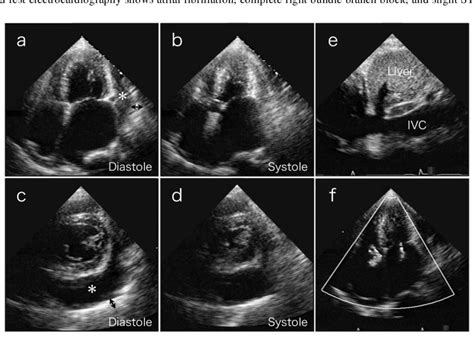 Transthoracic Echocardiography On 4 Chamber Views A And B And Short