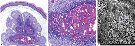 Treatment is usually recommended for anyone who has molluscum bumps. Atypical infantile genital Molluscum contagiosum
