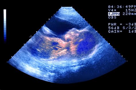 What To Expect At Your 20 Week Ultrasound