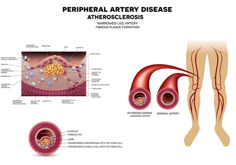 What Is Peripheral Artery Disease PAD Imaging Center Minimally Invasive Services