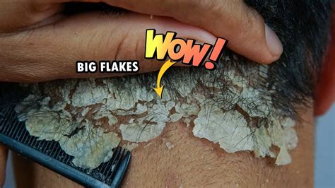 Psoriasis Scalp Scratching Big Flakes 1021 Youtube
