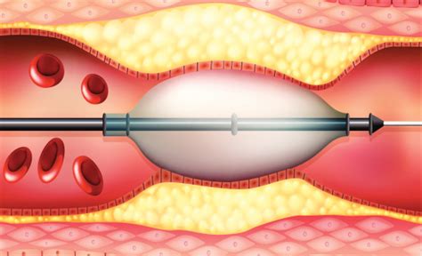 Angioplasty With Paclitaxel Coated Balloon Reduces Restenosis In