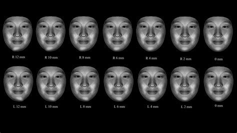 Assessing The Influence Of Chin Asymmetry On Perceived Facial Esthetics With Dimensional