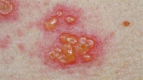 Shingles Patients In West Of England Needed For New Treatment Trial