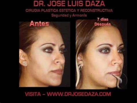 Subsecretaria de salud pública, pediatra, trabajando por una mejor salud para chile. Rinoplastia Dr Jose Daza Mexico City Aesthetic Rhinoplasty ...
