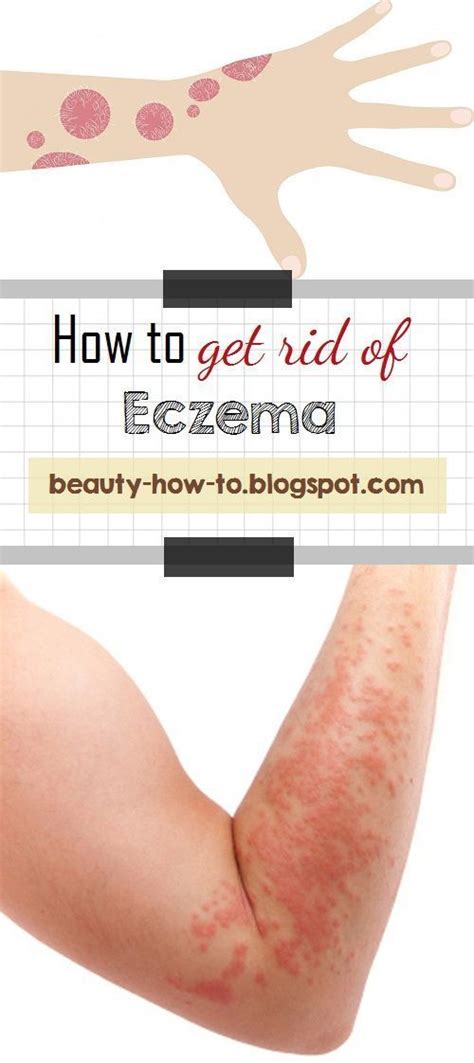 How To Get Rid Of Eczema In 2020 With Images Get Rid Of Eczema Eczema Skin Dryness