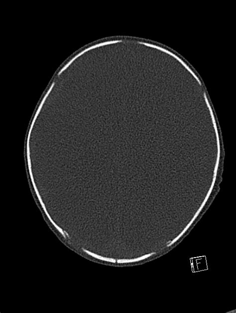 Bilateral Subdural Hemorrhage And Parietal Skull Fracture Radiopaedia