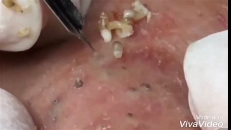 Pimple Popping 2020 Video 33 Blackhead Removal Whitehead Removal Acne Removal Acne Treatment