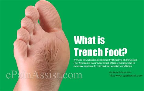 Trench Foot Ww1 In Color