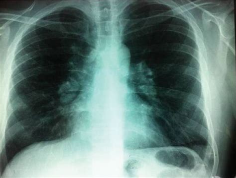 Chest Radiograph Of An Asymptomatic Man European Respiratory Society