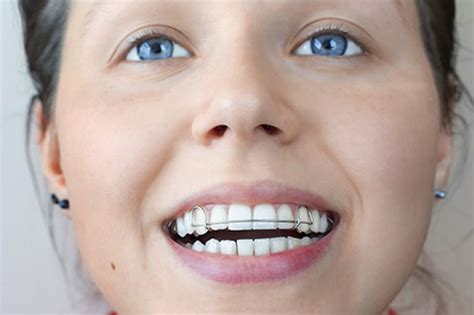 The sole purpose of wearing braces is of course to straighten crooked teeth and help keep your mouth in braces are typically worn for a couple of years, but the timing can vary. What Happens When Your Retainer No Longer Fits
