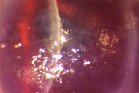 Corneal Epithelial Bullae Formation Figure 6 Anterior Segment Optical