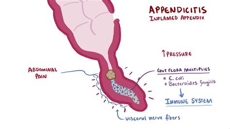 Appendicitis Symptomscausesdiagnosistreatment