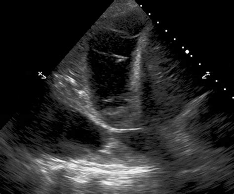 Learn about pleural effusion (fluid in the lung) symptoms like shortness of breath and chest pain. Lung Ultrasound Made Easy: Step-By-Step Guide - POCUS 101