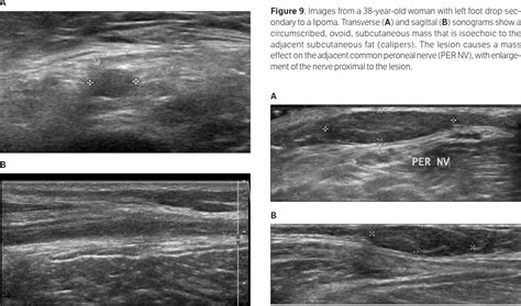 Pdf Sonographic Evaluation Of Common Peroneal Neuropathy In Patients