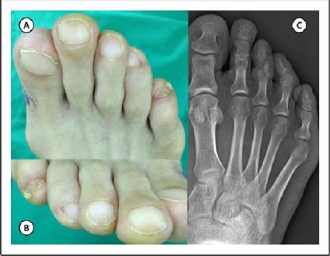 Operative Treatment For Fourth Curly Toe Deformity In Adults Semantic