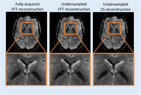 Advanced Signal Processing Techniques Schmidt Mri Lab